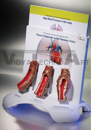 Pulmonary Arterial Hypertension Model